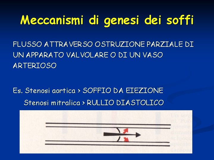 Meccanismi di genesi dei soffi FLUSSO ATTRAVERSO OSTRUZIONE PARZIALE DI UN APPARATO VALVOLARE O