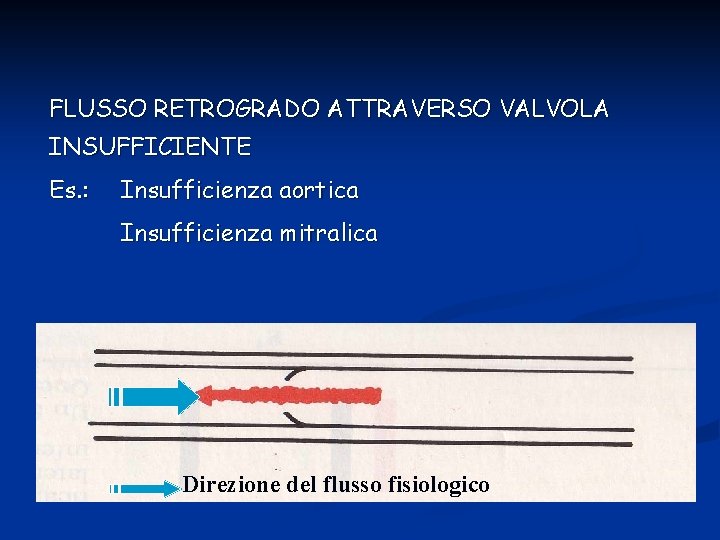 FLUSSO RETROGRADO ATTRAVERSO VALVOLA INSUFFICIENTE Es. : Insufficienza aortica Insufficienza mitralica Direzione del flusso