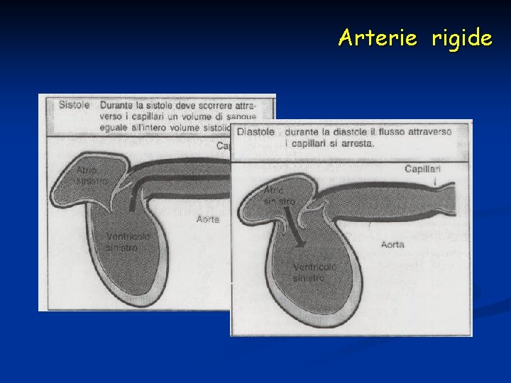 Arterie rigide 