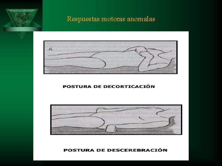 Respuestas motoras anomalas 