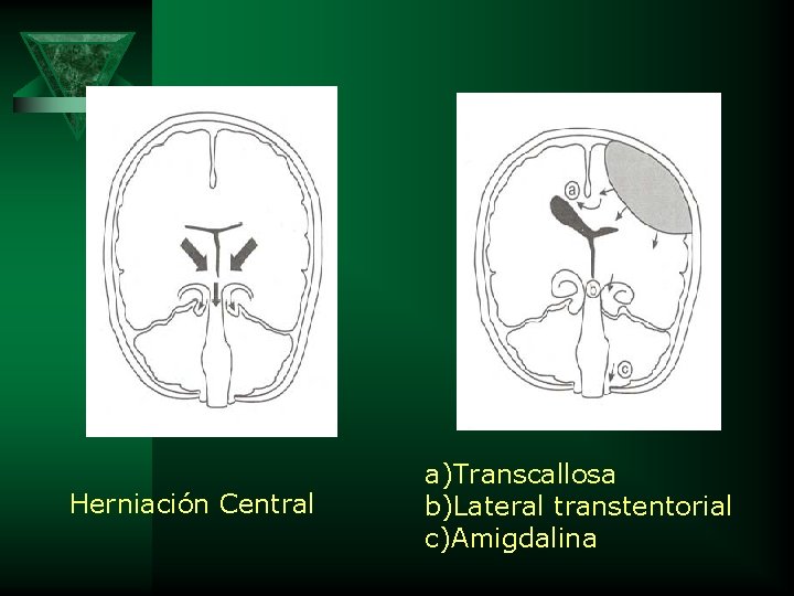 Herniación Central a)Transcallosa b)Lateral transtentorial c)Amigdalina 
