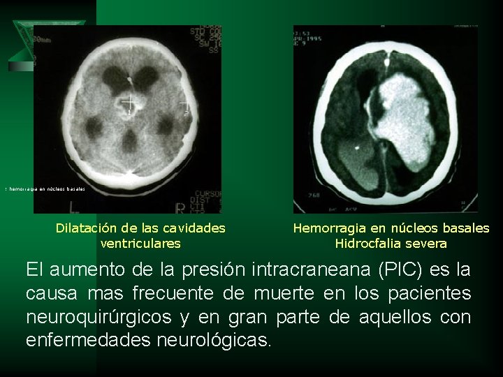 : hemorragia en núcleos basales Dilatación de las cavidades ventriculares Hemorragia en núcleos basales