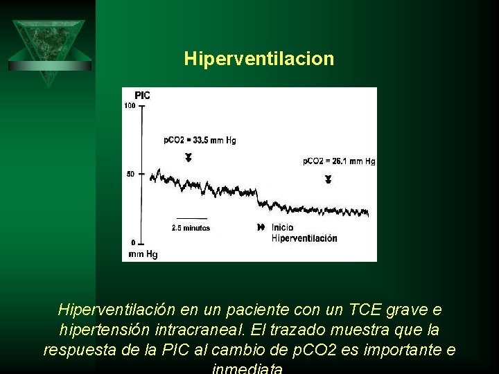 Hiperventilacion Hiperventilación en un paciente con un TCE grave e hipertensión intracraneal. El trazado