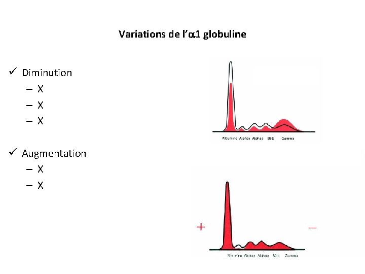 Variations de l’ 1 globuline ü Diminution – X – X ü Augmentation –