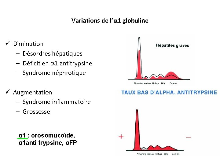 Variations de l’ 1 globuline ü Diminution – Désordres hépatiques – Déficit en 1