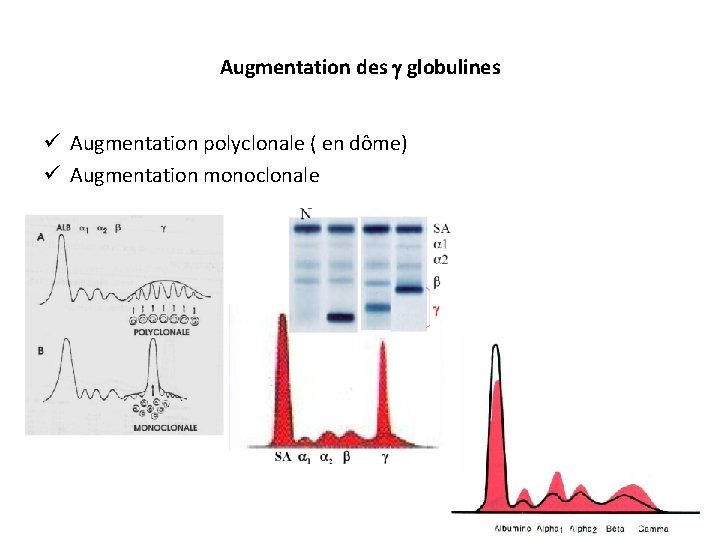 Augmentation des globulines ü Augmentation polyclonale ( en dôme) ü Augmentation monoclonale 