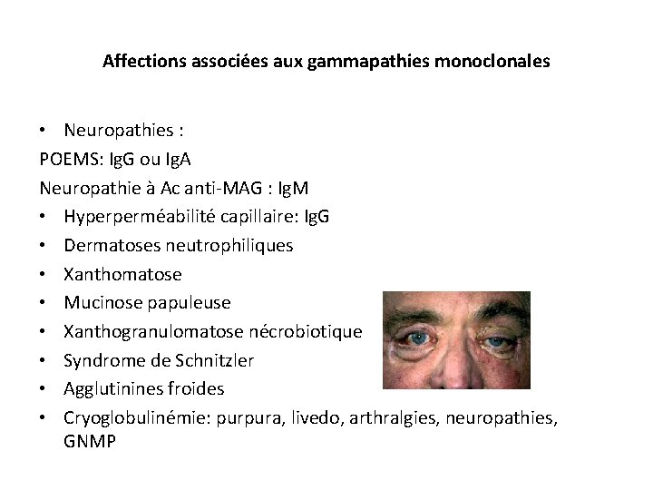 Affections associées aux gammapathies monoclonales • Neuropathies : POEMS: Ig. G ou Ig. A