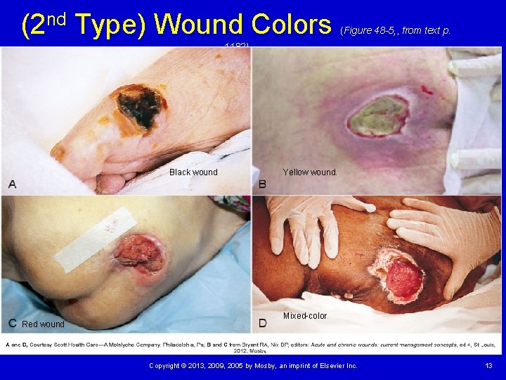 (2 nd Type) Wound Colors (Figure 48 -5, , from text p. 1182) Black (2 nd Type) Wound Colors (Figure 48 -5, , from text p. 1182) Black