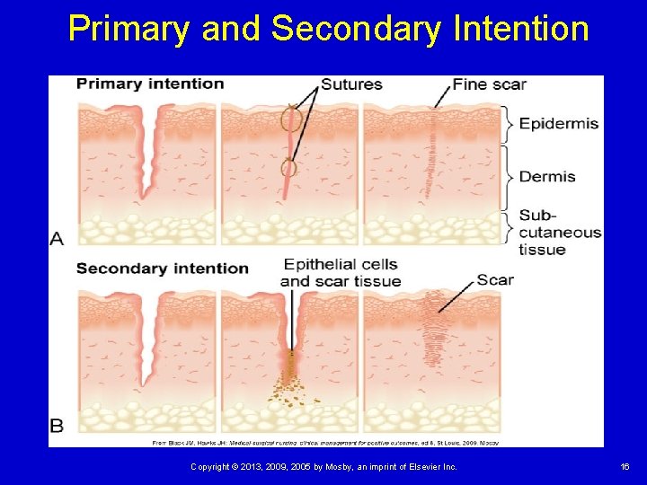Primary and Secondary Intention Copyright © 2013, 2009, 2005 by Mosby, an imprint of Primary and Secondary Intention Copyright © 2013, 2009, 2005 by Mosby, an imprint of