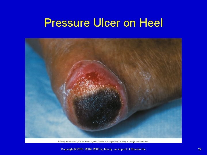Pressure Ulcer on Heel Copyright © 2013, 2009, 2005 by Mosby, an imprint of Pressure Ulcer on Heel Copyright © 2013, 2009, 2005 by Mosby, an imprint of