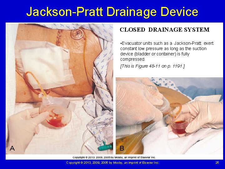 Jackson-Pratt Drainage Device CLOSED DRAINAGE SYSTEM • Evacuator units such as a Jackson-Pratt exert Jackson-Pratt Drainage Device CLOSED DRAINAGE SYSTEM • Evacuator units such as a Jackson-Pratt exert