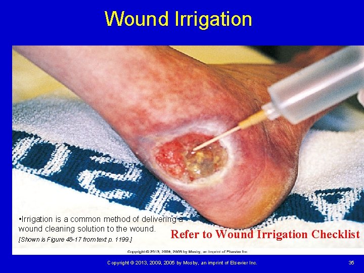 Wound Irrigation • Irrigation is a common method of delivering a wound cleaning solution Wound Irrigation • Irrigation is a common method of delivering a wound cleaning solution