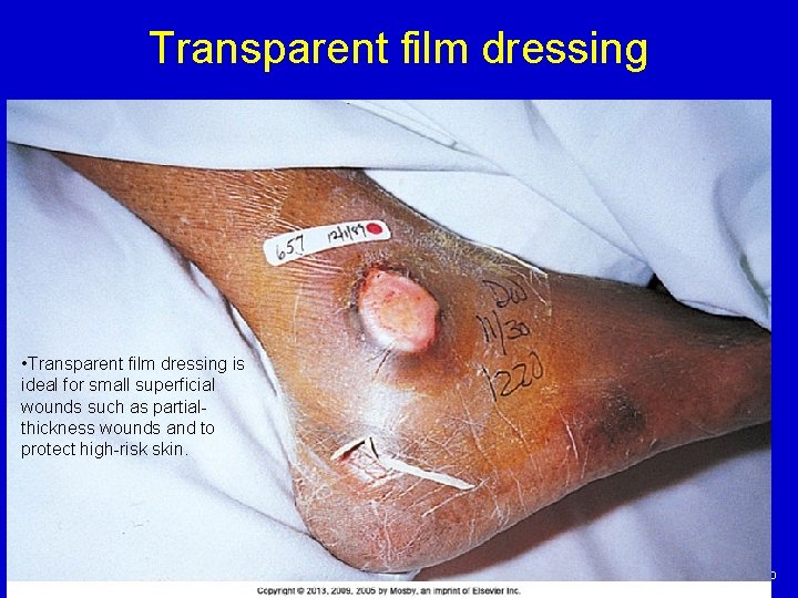 Transparent film dressing • Transparent film dressing is ideal for small superficial wounds such Transparent film dressing • Transparent film dressing is ideal for small superficial wounds such