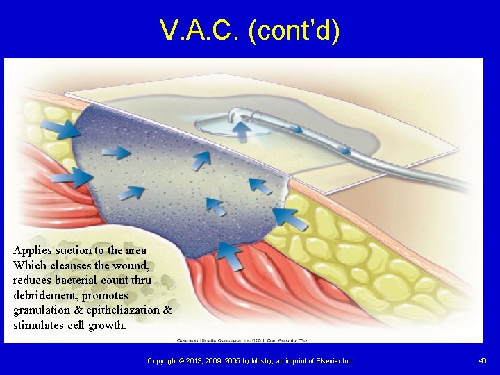 V. A. C. (cont’d) Applies suction to the area Which cleanses the wound, reduces V. A. C. (cont’d) Applies suction to the area Which cleanses the wound, reduces