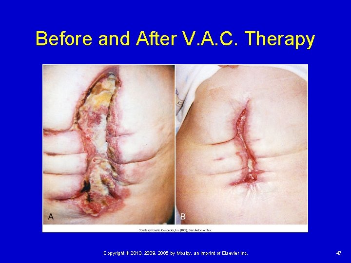 Before and After V. A. C. Therapy Copyright © 2013, 2009, 2005 by Mosby, Before and After V. A. C. Therapy Copyright © 2013, 2009, 2005 by Mosby,