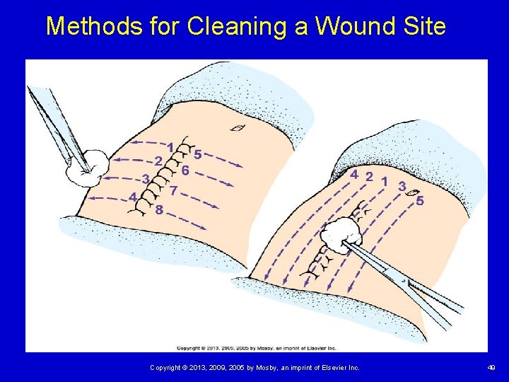 Methods for Cleaning a Wound Site Copyright © 2013, 2009, 2005 by Mosby, an Methods for Cleaning a Wound Site Copyright © 2013, 2009, 2005 by Mosby, an