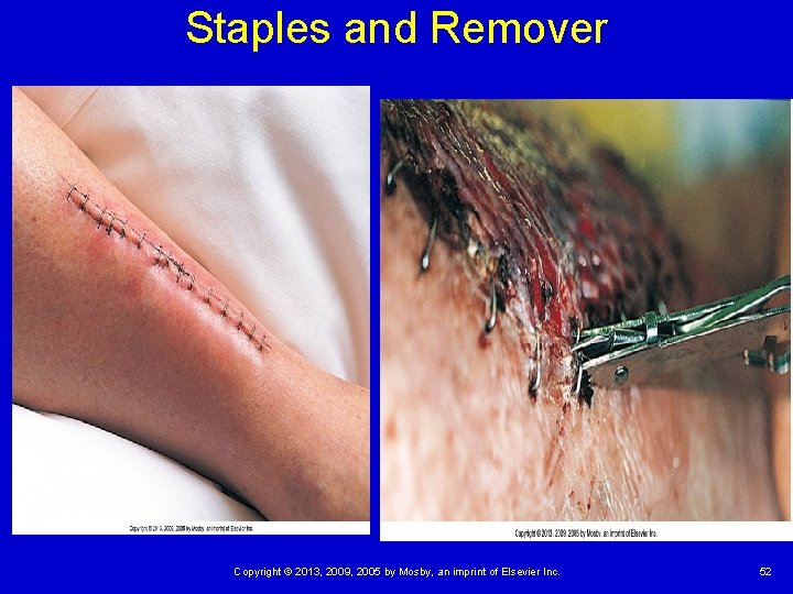 Staples and Remover Copyright © 2013, 2009, 2005 by Mosby, an imprint of Elsevier Staples and Remover Copyright © 2013, 2009, 2005 by Mosby, an imprint of Elsevier