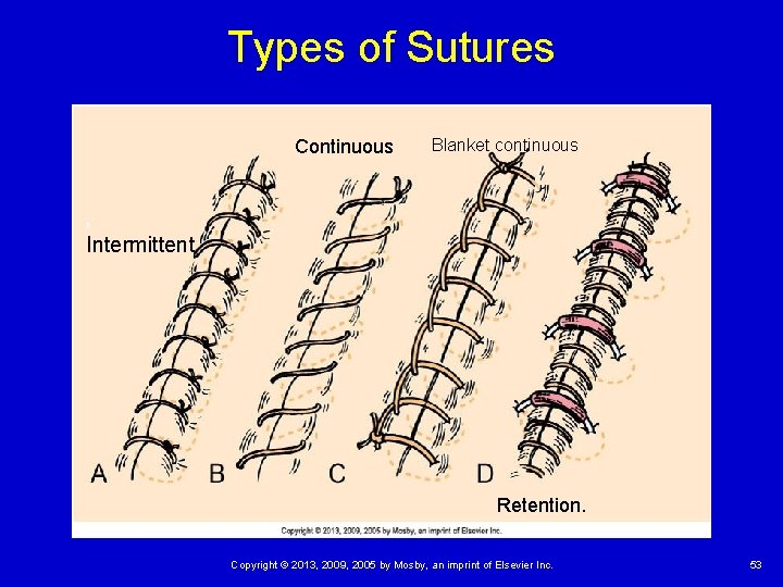 Types of Sutures Continuous Blanket continuous , Intermittent Retention. Copyright © 2013, 2009, 2005 Types of Sutures Continuous Blanket continuous , Intermittent Retention. Copyright © 2013, 2009, 2005