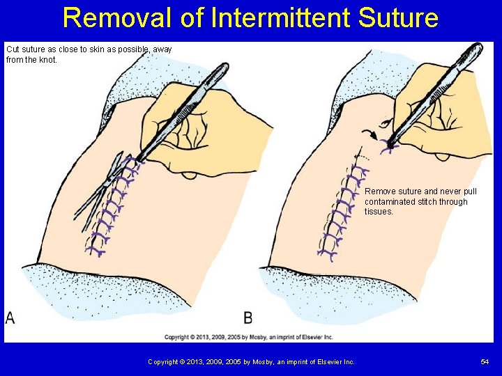 Removal of Intermittent Suture Cut suture as close to skin as possible, away from Removal of Intermittent Suture Cut suture as close to skin as possible, away from