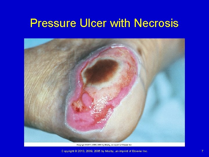 Pressure Ulcer with Necrosis Copyright © 2013, 2009, 2005 by Mosby, an imprint of Pressure Ulcer with Necrosis Copyright © 2013, 2009, 2005 by Mosby, an imprint of
