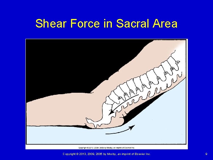 Shear Force in Sacral Area Copyright © 2013, 2009, 2005 by Mosby, an imprint Shear Force in Sacral Area Copyright © 2013, 2009, 2005 by Mosby, an imprint