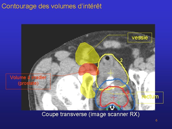 Contourage des volumes d’intérêt vessie Volume à irradier (prostate) rectum Coupe transverse (image scanner