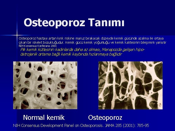 Osteoporoz Tanımı Osteoporoz hastayı artan kırık riskine maruz bırakacak düzeyde kemik gücünde azalma ile