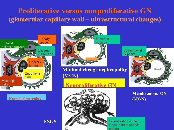 Proliferative versus nonproliferative GN (glomerular capillary wall – ultrastructural changes) Epitelial cells=podocytes Urinary space