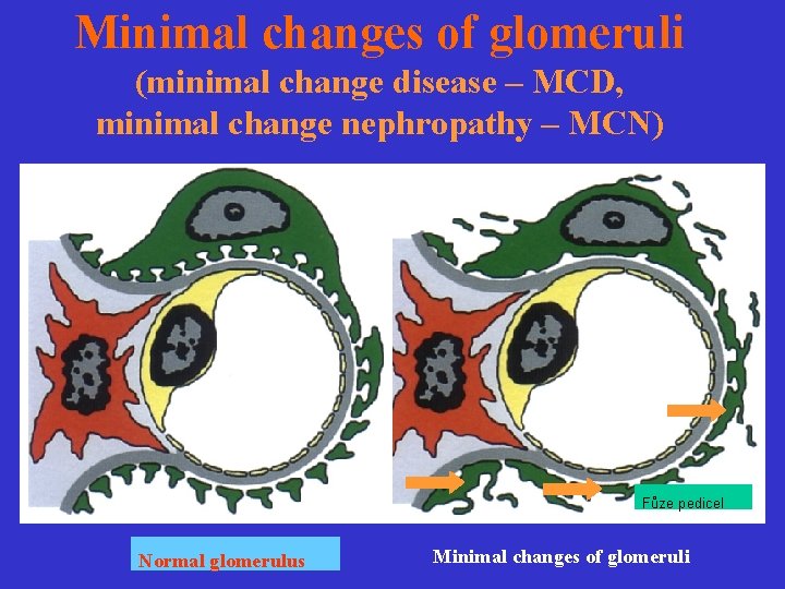 Minimal changes of glomeruli (minimal change disease – MCD, minimal change nephropathy – MCN)