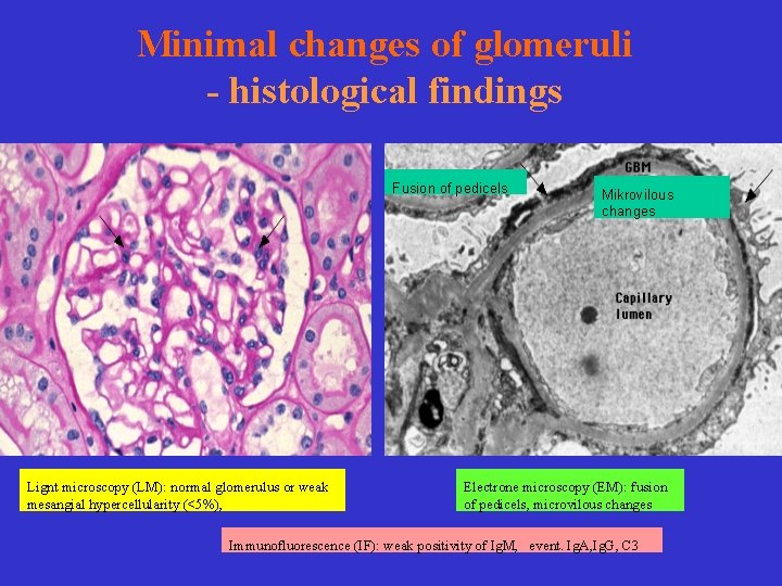 Minimal changes of glomeruli - histological findings Fusion of pedicels Lignt microscopy (LM): normal