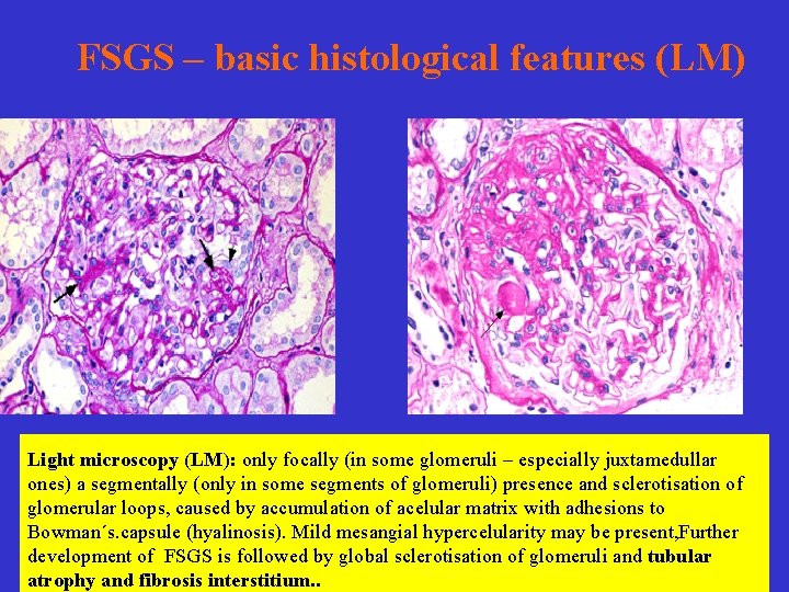 FSGS – basic histological features (LM) Light microscopy (LM): only focally (in some glomeruli