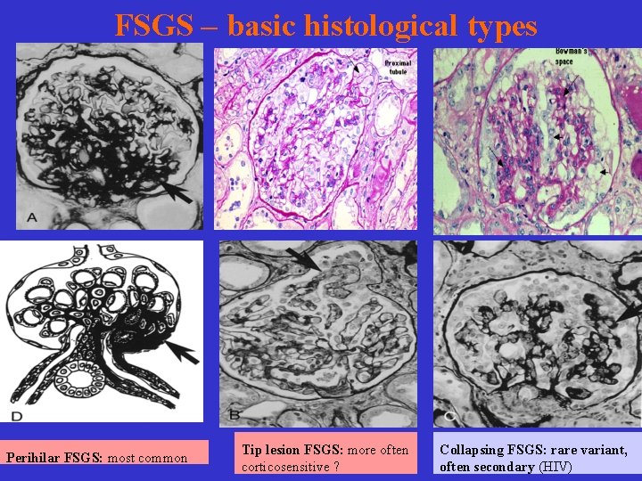 FSGS – basic histological types Perihilar FSGS: most common Tip lesion FSGS: more often