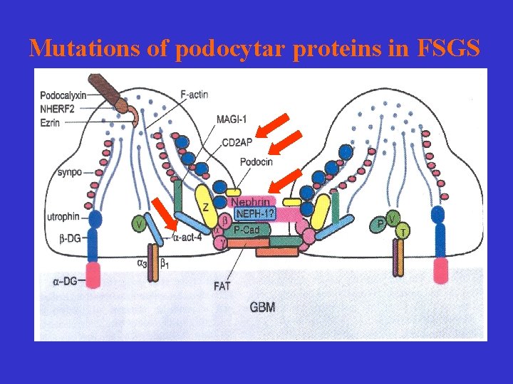 Mutations of podocytar proteins in FSGS 