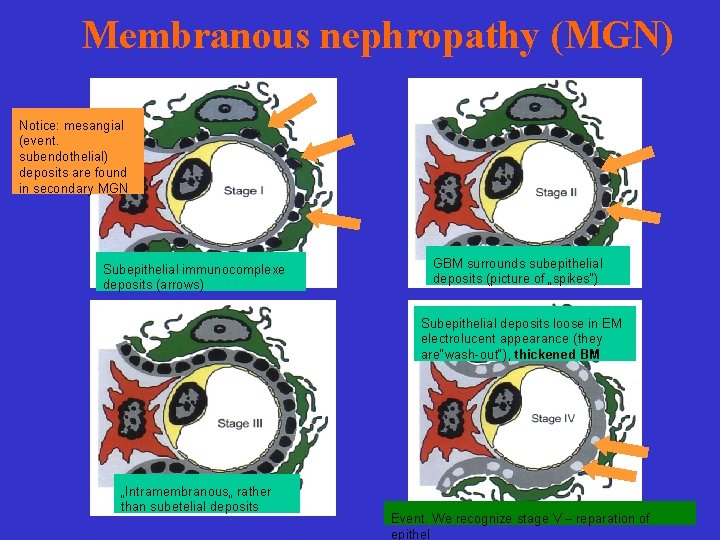 Membranous nephropathy (MGN) Notice: mesangial (event. subendothelial) deposits are found in secondary MGN Subepithelial