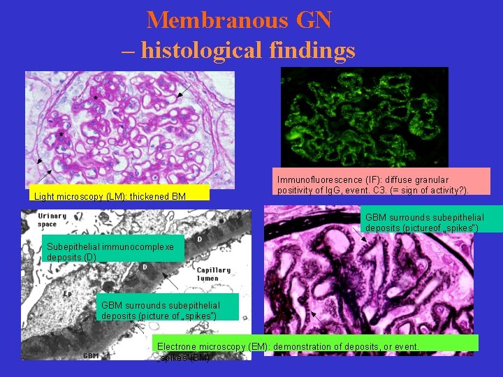 Membranous GN – histological findings Light microscopy (LM): thickened BM Immunofluorescence (IF): diffuse granular