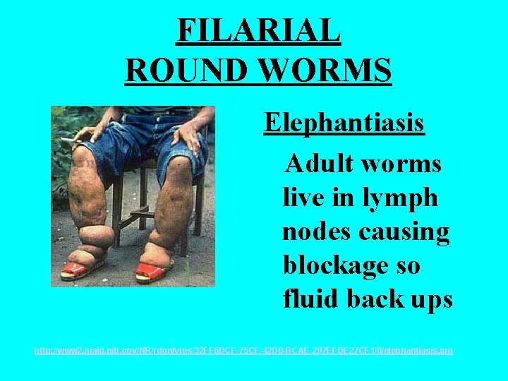 FILARIAL ROUND WORMS Elephantiasis Adult worms live in lymph nodes causing blockage so fluid