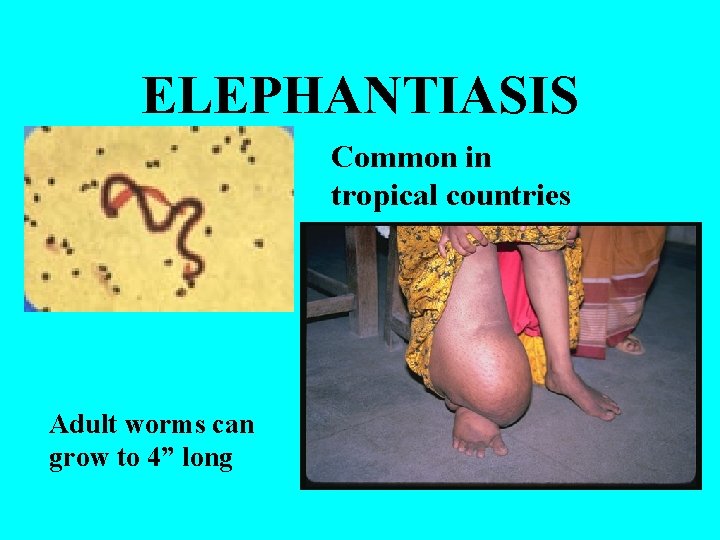 ELEPHANTIASIS Common in tropical countries Adult worms can grow to 4” long 