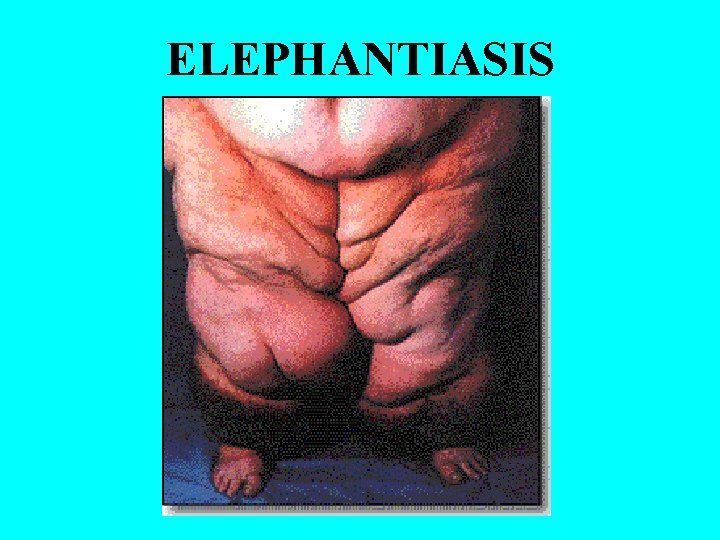 ELEPHANTIASIS 