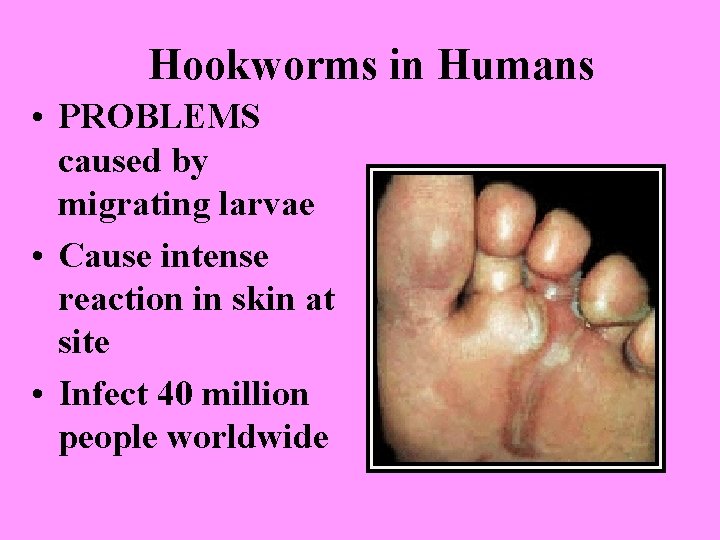 Hookworms in Humans • PROBLEMS caused by migrating larvae • Cause intense reaction in