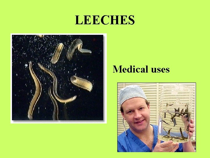 LEECHES Medical uses 