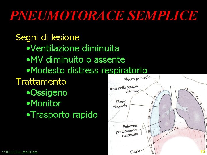 PNEUMOTORACE SEMPLICE Segni di lesione • Ventilazione diminuita • MV diminuito o assente •