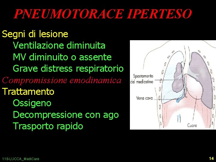 PNEUMOTORACE IPERTESO Segni di lesione Ventilazione diminuita MV diminuito o assente Grave distress respiratorio