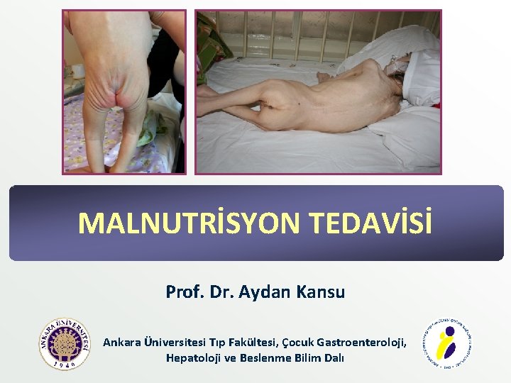 MALNUTRİSYON TEDAVİSİ Prof. Dr. Aydan Kansu Ankara Üniversitesi Tıp Fakültesi, Çocuk Gastroenteroloji, Hepatoloji ve MALNUTRİSYON TEDAVİSİ Prof. Dr. Aydan Kansu Ankara Üniversitesi Tıp Fakültesi, Çocuk Gastroenteroloji, Hepatoloji ve