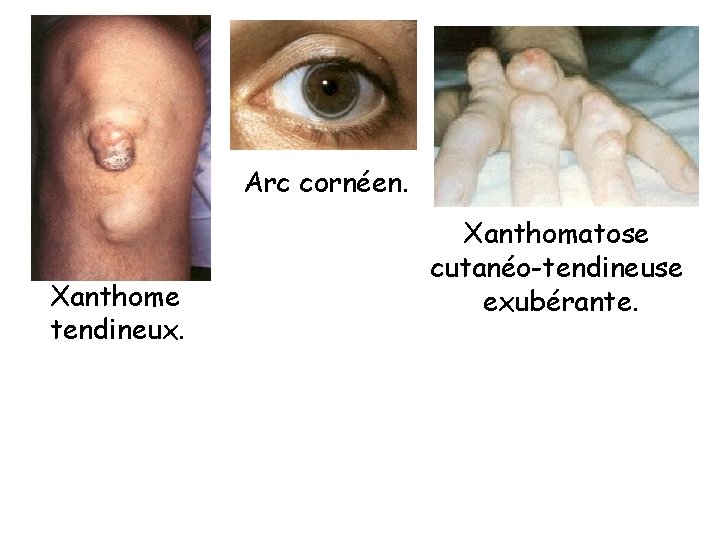 Arc cornéen. Xanthome tendineux. Xanthomatose cutanéo-tendineuse exubérante. 