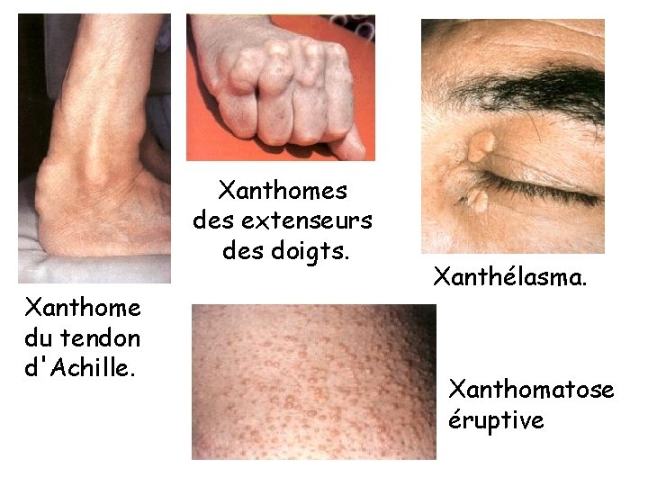 Xanthomes des extenseurs des doigts. Xanthome du tendon d'Achille. Xanthélasma. Xanthomatose éruptive 