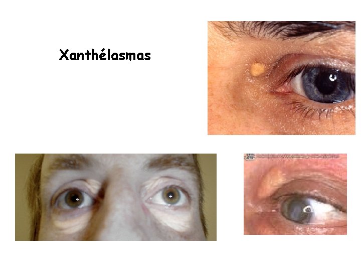 Xanthélasmas 