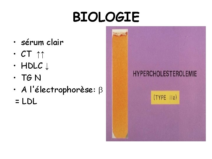 BIOLOGIE • sérum clair • CT ↑↑ • HDLC ↓ • TG N •