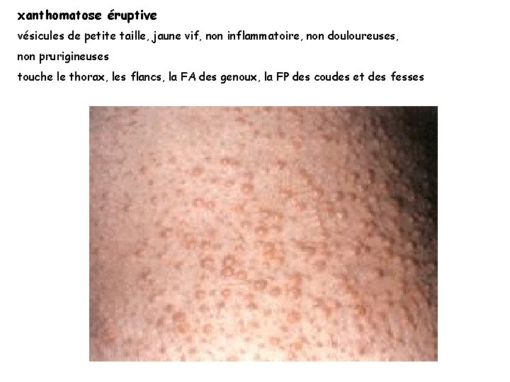 xanthomatose éruptive vésicules de petite taille, jaune vif, non inflammatoire, non douloureuses, non prurigineuses