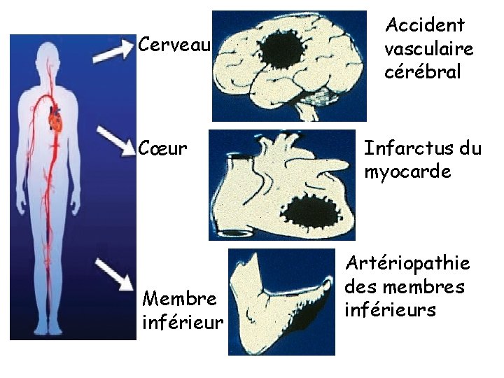 Cerveau Cœur Membre inférieur Accident vasculaire cérébral Infarctus du myocarde Artériopathie des membres inférieurs