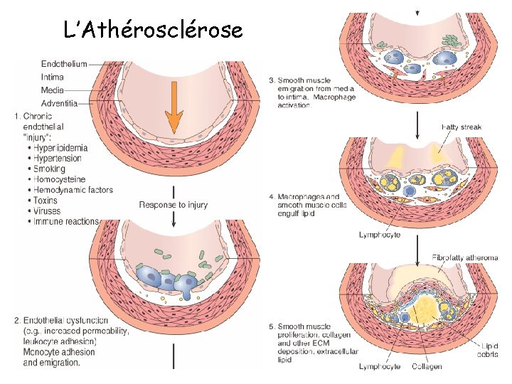 L’Athérosclérose 
